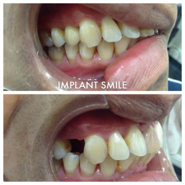 Implant Surgery