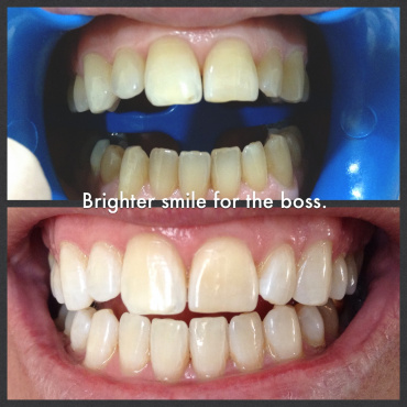 Zoom Teeth whitening