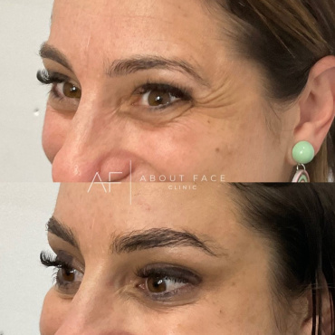 Anti-wrinkle injections available