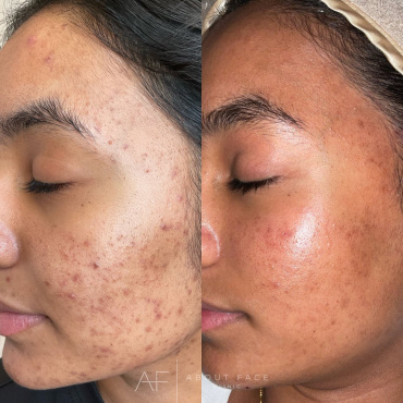 advanced skin treatments for all skin types